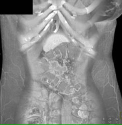 Carcinomatosis With Implant on Omentum - CTisus CT Scan