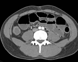 Ulcerative Colitis Ascending Colon With Stricture - CTisus CT Scan