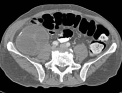 Metastatic Ovarian Cancer to Cecum - CTisus CT Scan