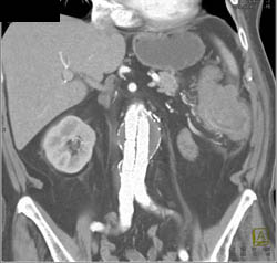 Diverticulitis Descending Colon With Abscess - CTisus CT Scan