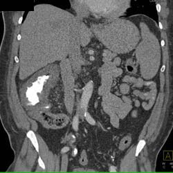 Pseudomembranous Colitis (PMC) - CTisus CT Scan