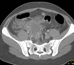 Missed Appendiceal Abscess - CTisus CT Scan