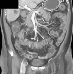 Colitis With Right Lower Quadrant Abscess - CTisus CT Scan