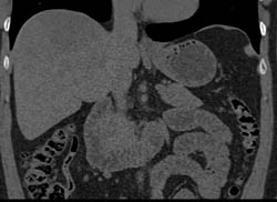 High Positioned Appendix - CTisus CT Scan