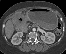 Perforated Gastric Ulcer Due to Cancer - CTisus CT Scan