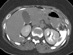 Gastric Perforation With Free Contrast - CTisus CT Scan