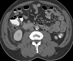 Diverticulitis - CTisus CT Scan