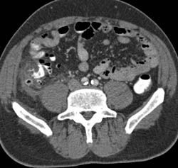 Diverticulitis - CTisus CT Scan