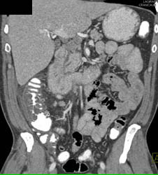 Diverticulitis - CTisus CT Scan