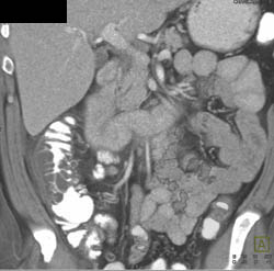 Diverticulitis - CTisus CT Scan