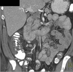 Diverticulitis - CTisus CT Scan