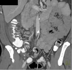 Diverticulitis - CTisus CT Scan