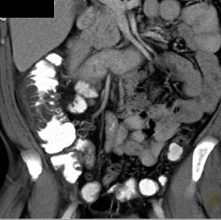 Diverticulitis - CTisus CT Scan