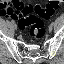 Colon Cancer - CTisus CT Scan