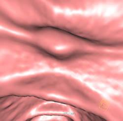 Polyp - CTisus CT Scan