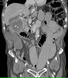 Small Bowel Obstruction Due to Recurrent Colon Cancer - CTisus CT Scan