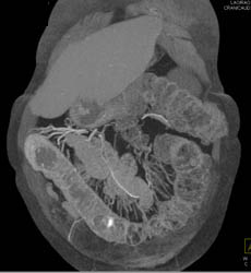 Ischemic Colitis - CTisus CT Scan