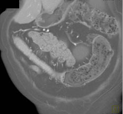 Crohn's With Prominent Vasa Recta - CTisus CT Scan