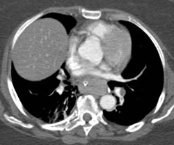 Colitis Colon With Mild Small Bowel Obstruction and Colon Cancer at Splenic Flexure - CTisus CT Scan