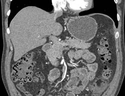 Left Sided Diverticulitis - CTisus CT Scan