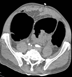 Colon Cancer With Obstruction - CTisus CT Scan