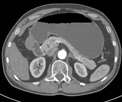 Colitis Transverse Colon - CTisus CT Scan