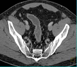 Ischemic Colitis - CTisus CT Scan