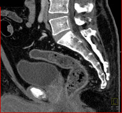 Ischemic Colitis - CTisus CT Scan