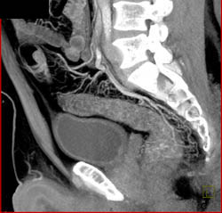 Ischemic Colitis - CTisus CT Scan