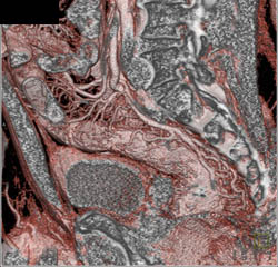 Ischemic Colitis - CTisus CT Scan