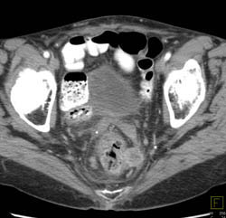 Implants Around Rectum - CTisus CT Scan