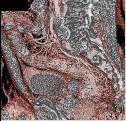 Prominent Vessels Involving the Rectum in Colitis - CTisus CT Scan