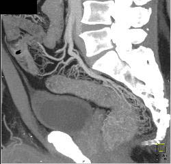 Prominent Vessels Involving the Rectum in Colitis - CTisus CT Scan