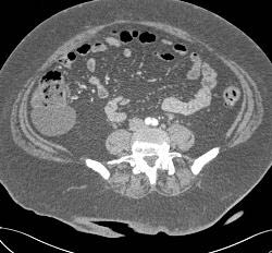 Duplication Cyst Off Cecum - CTisus CT Scan