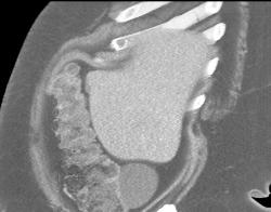 Duplication Cyst Off Cecum - CTisus CT Scan