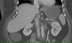 Duplication Cyst Off Cecum - CTisus CT Scan