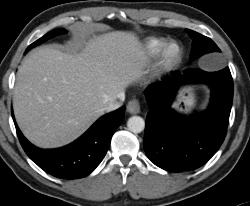 Ulcerative Colitis - CTisus CT Scan