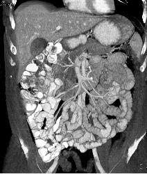 3D of Small Bowel - CTisus CT Scan