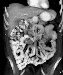 3D of Small Bowel - CTisus CT Scan