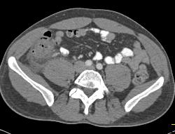 Perforated Diverticulitis - CTisus CT Scan