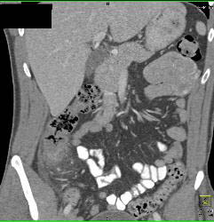 Perforated Diverticulitis - CTisus CT Scan