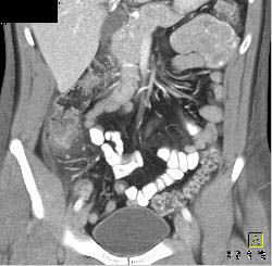 Perforated Diverticulitis - CTisus CT Scan