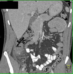 Perforated Diverticulitis - CTisus CT Scan