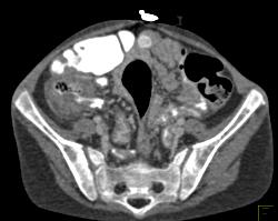 Pseudomembranous Colitis - CTisus CT Scan