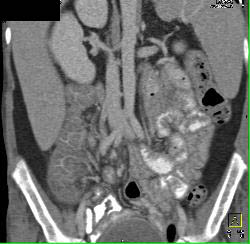 Pseudomembranous Colitis - CTisus CT Scan