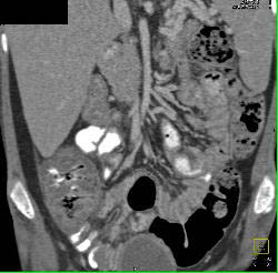 Pseudomembranous Colitis - CTisus CT Scan