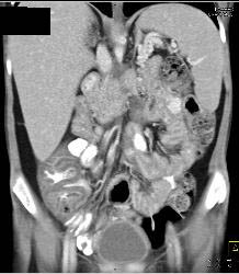 Pseudomembranous Colitis - CTisus CT Scan