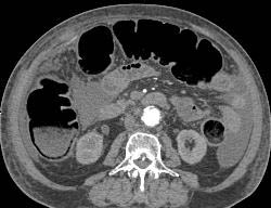 Pneumatosis Coli in Cecum - CTisus CT Scan