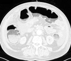 Pneumatosis Coli in Cecum - CTisus CT Scan