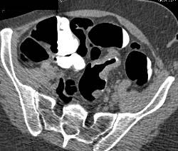 Sigmoid Colon Cancer - CTisus CT Scan